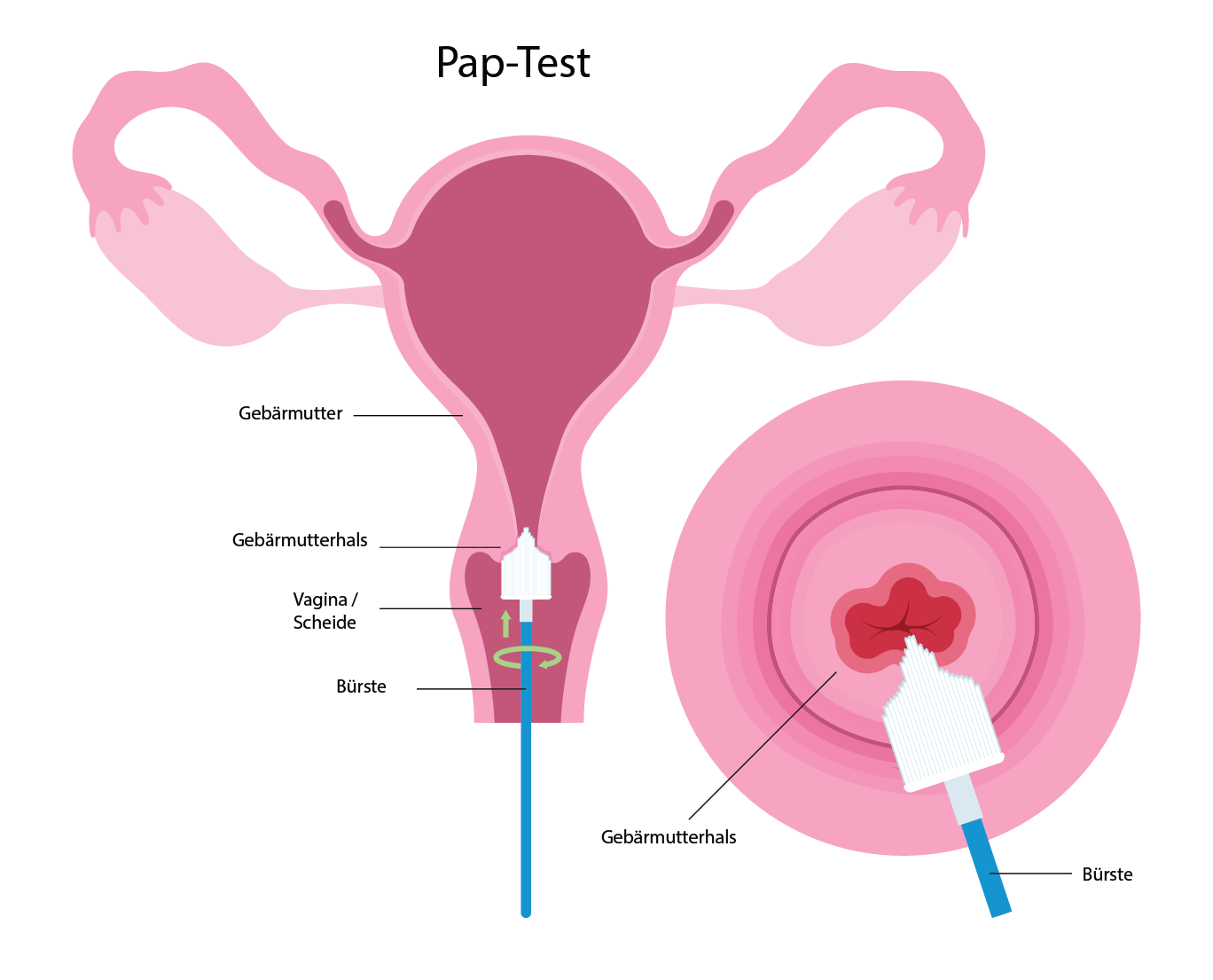 Schema der inneren, weiblichen Geschlechtsorgane. Ein Bürstchen nimmt Abstrich am Gebärmutterhals für den Pap-Test vor.