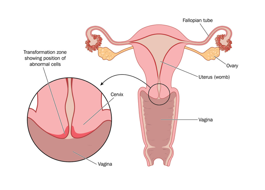 Cervical Cancer Cervical Cancer